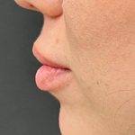 Lip Filler Before & After Patient #8079