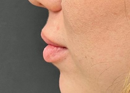 Lip Filler Before & After Patient #8079