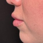 Lip Filler Before & After Patient #8079