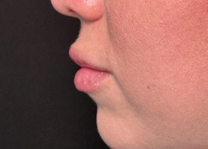 Lip Filler Before & After Patient #8079