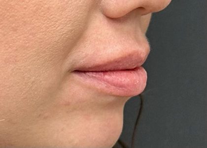Lip Filler Before & After Patient #8079