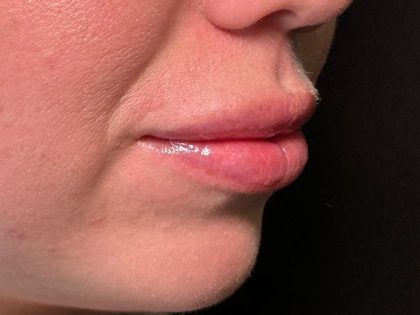 Lip Filler Before & After Patient #8079