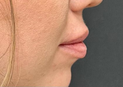 Lip Filler Before & After Patient #8079