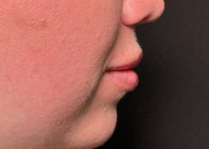 Lip Filler Before & After Patient #8079