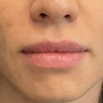 Lip Filler Before & After Patient #8082