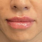 Lip Filler Before & After Patient #8082