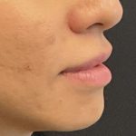 Lip Filler Before & After Patient #8082
