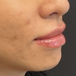 Lip Filler Before & After Patient #8082