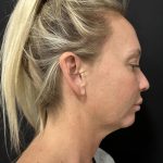MyEllevate Before & After Patient #8139