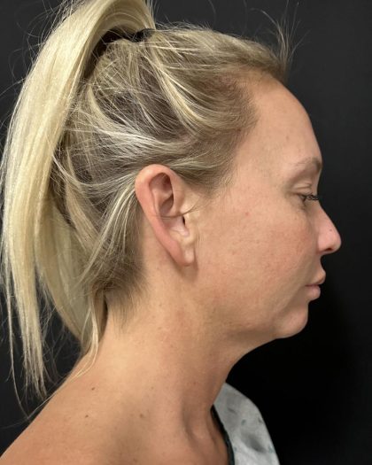 MyEllevate Before & After Patient #8139