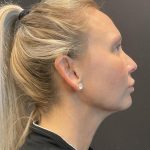 MyEllevate Before & After Patient #8139