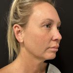 MyEllevate Before & After Patient #8139