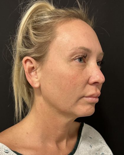 MyEllevate Before & After Patient #8139