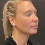 MyEllevate Before & After Patient #8139