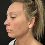 MyEllevate Before & After Patient #8139
