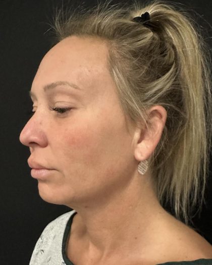 MyEllevate Before & After Patient #8139