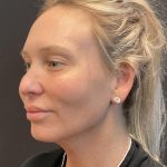 MyEllevate Before & After Patient #8139