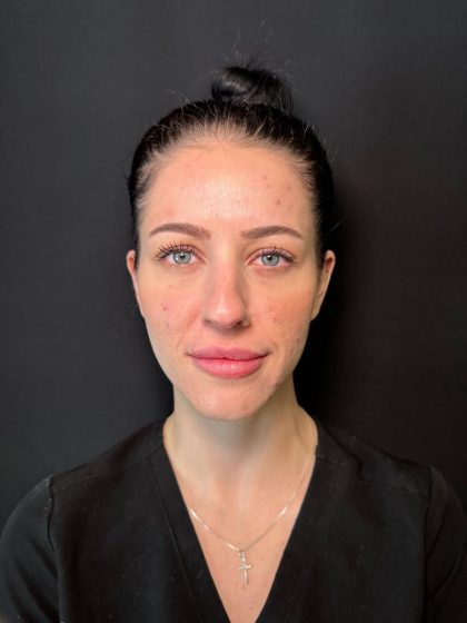 Neurotoxin Before & After Patient #8083