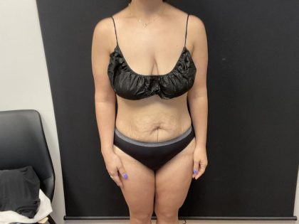 The Skinny Shot Before & After Patient #8127