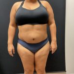 The Skinny Shot Before & After Patient #8125