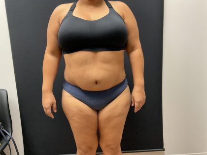 The Skinny Shot Before & After Patient #8125