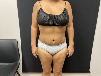 The Skinny Shot Before & After Patient #8125