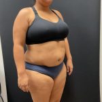 The Skinny Shot Before & After Patient #8125