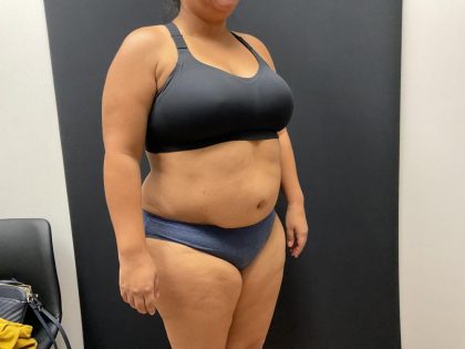 The Skinny Shot Before & After Patient #8125