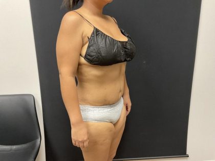 The Skinny Shot Before & After Patient #8125