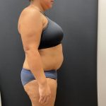 The Skinny Shot Before & After Patient #8125