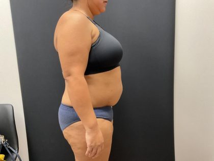 The Skinny Shot Before & After Patient #8125