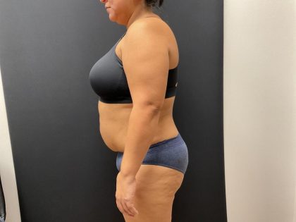 The Skinny Shot Before & After Patient #8125