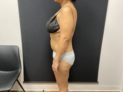 The Skinny Shot Before & After Patient #8125