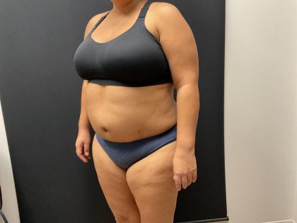 The Skinny Shot Before & After Patient #8125
