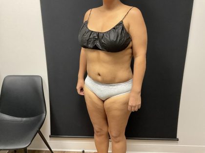 The Skinny Shot Before & After Patient #8125