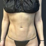 Soft Definition Liposuction Before & After Patient #8181