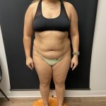 The Skinny Shot Before & After Patient #8126