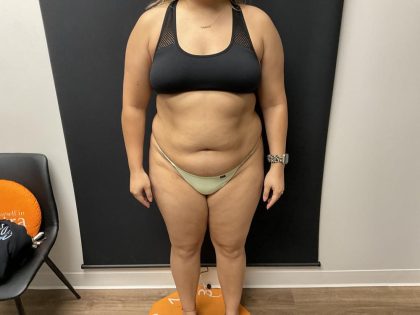 The Skinny Shot Before & After Patient #8126