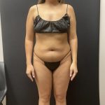 The Skinny Shot Before & After Patient #8126