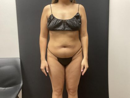 The Skinny Shot Before & After Patient #8126
