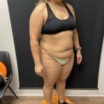 The Skinny Shot Before & After Patient #8126