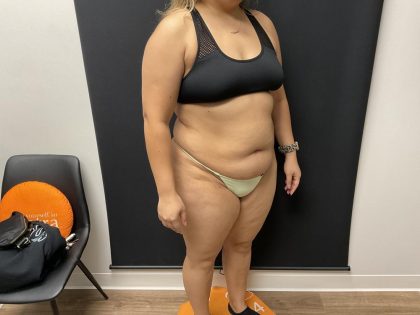 The Skinny Shot Before & After Patient #8126