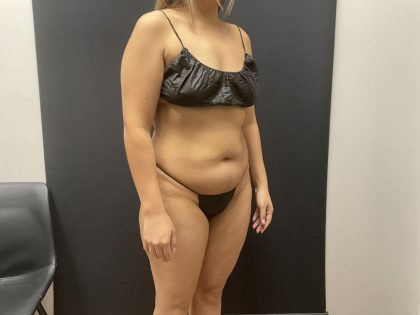 The Skinny Shot Before & After Patient #8126
