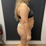 The Skinny Shot Before & After Patient #8126