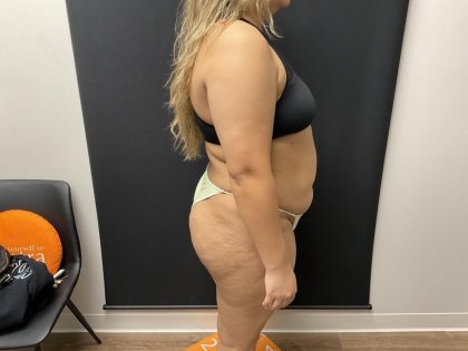 The Skinny Shot Before & After Patient #8126