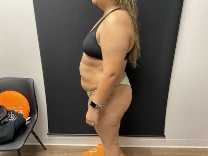 The Skinny Shot Before & After Patient #8126