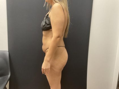 The Skinny Shot Before & After Patient #8126