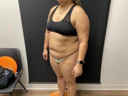 The Skinny Shot Before & After Patient #8126