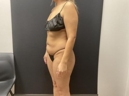 The Skinny Shot Before & After Patient #8126