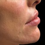 Lip Filler Before & After Patient #9573